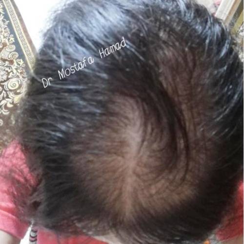 تكلفة زراعة الشعر للنساء في مصر