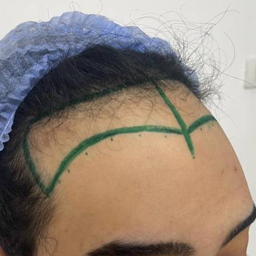 تكلفة زراعة الشعر للنساء في مصر 