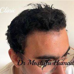 تقنية dhi لزراعة الشعر 